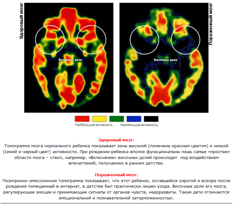 zdorvyy-i-porazhennyy-mozg-rebenka